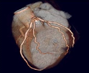 Heart. Radiology image